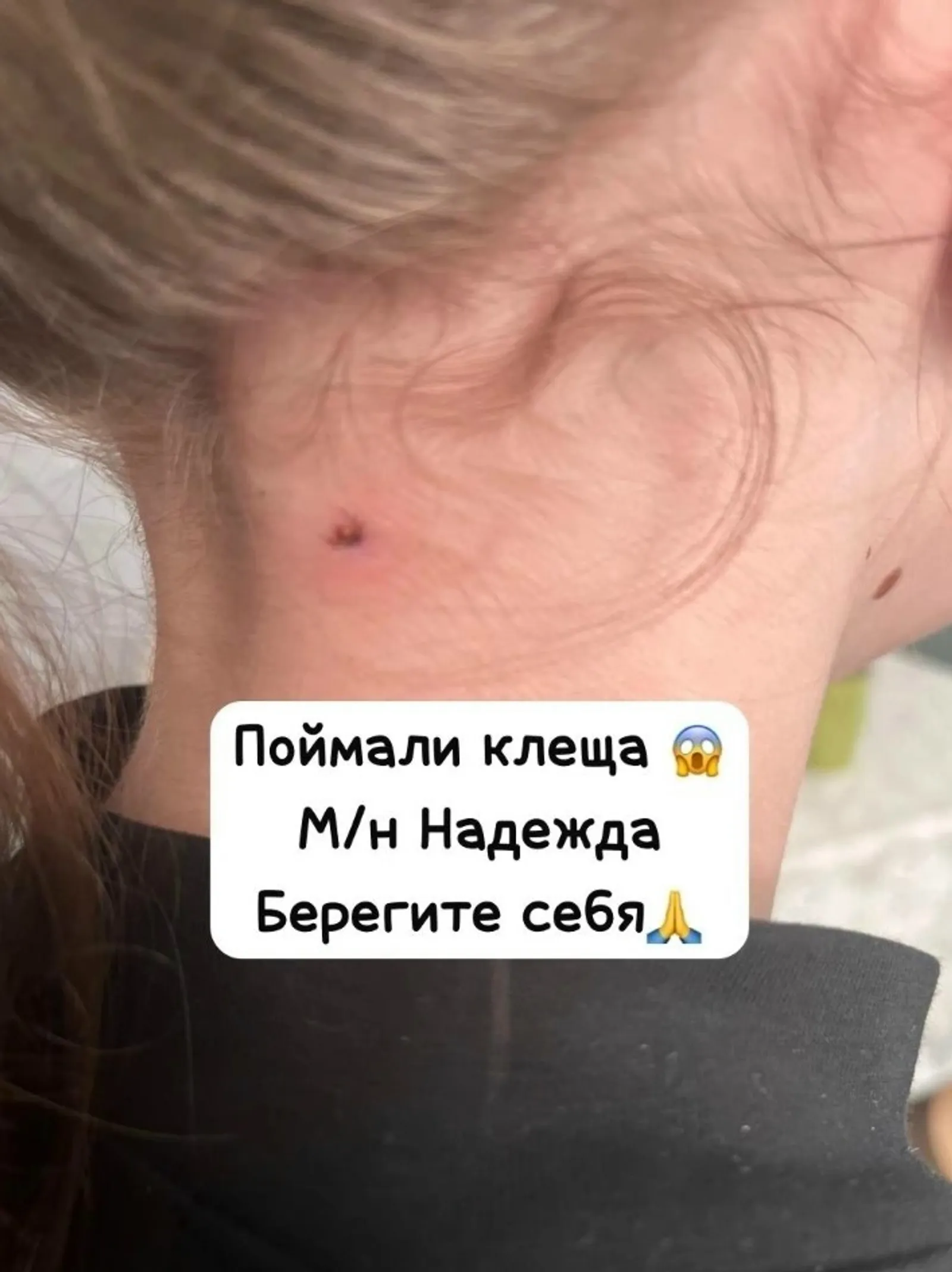На шее у девятилетней девочки из Благовещенска обнаружили клеща